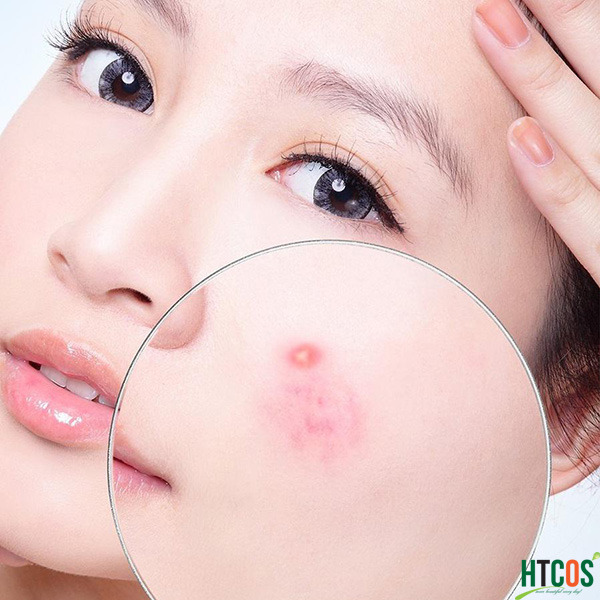 Kem trị mụn Shiseido Pimplit Nhật Bản
