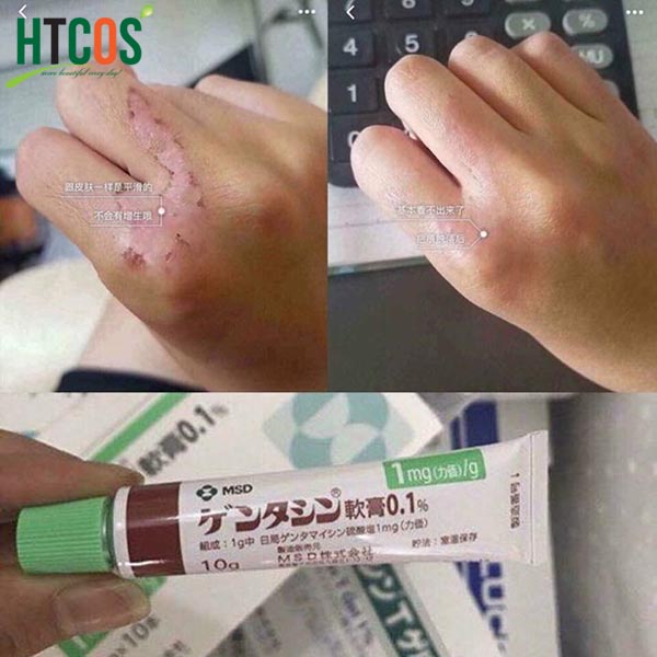 (Kem trị sẹo Gentacin Nhật Bản được người tiêu dùng khắp nơi yêu thích)