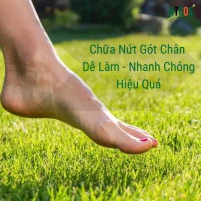 Cách Trị Nứt Gót Chân Dễ Làm