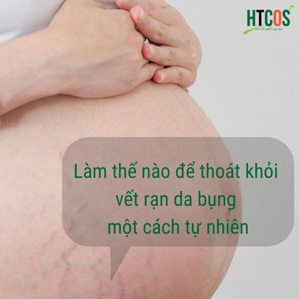 Rạn da bụng là gì