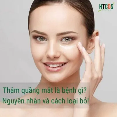 Thâm quầng mắt là bệnh gì?