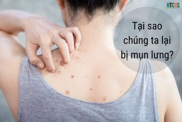 Tại sao chúng ta bị mụn lưng?