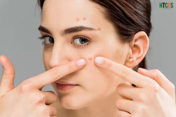 Xóa sẹo mụn trứng cá hiệu quả